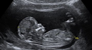 Ultrassom de bebê (Foto: Reprodução)