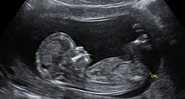 Ultrassom de bebê (Foto: Reprodução)