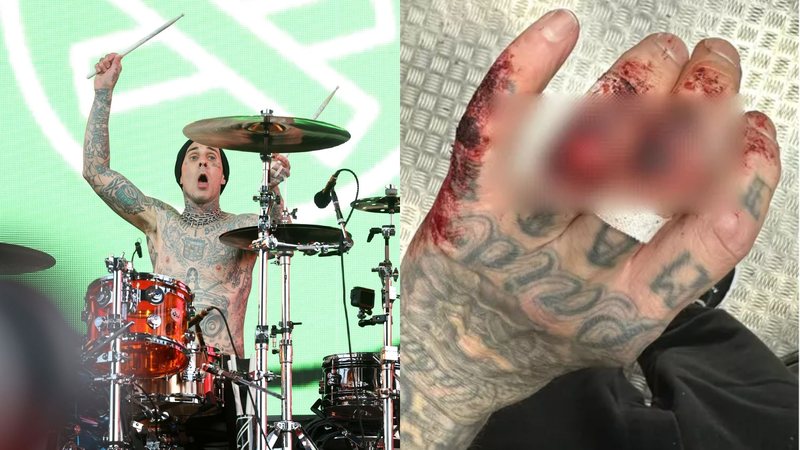 Travis Barker (Foto: Getty Images) e mão machucada (Reprodução/Instagram)