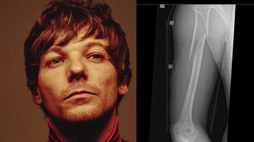Louis Tomlinson quebra o braço após show em Nova York (Foto: divulgação / reprodução Instagram)